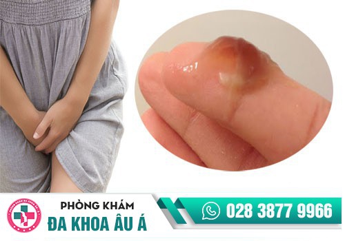 Nguyên nhân chậm kinh ra máu màu nâu là gì?